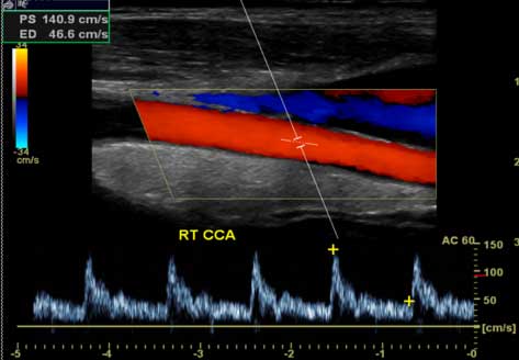 Doppler carotide